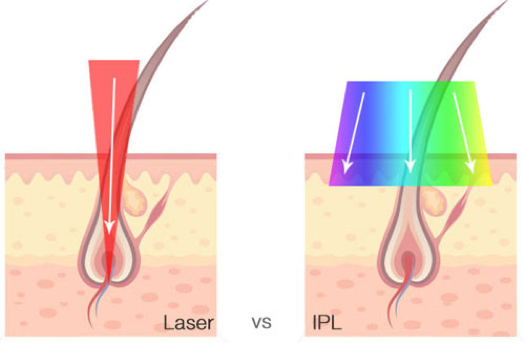 diferencia-depilacion-ipl-laser